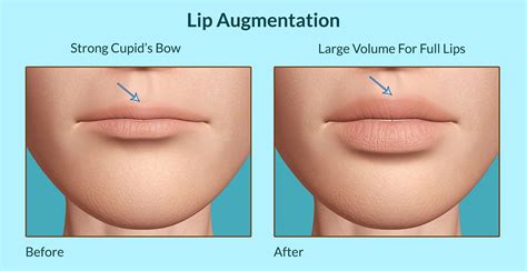 Magical Lip Plumpers: Achieving Fuller Lips without Injections